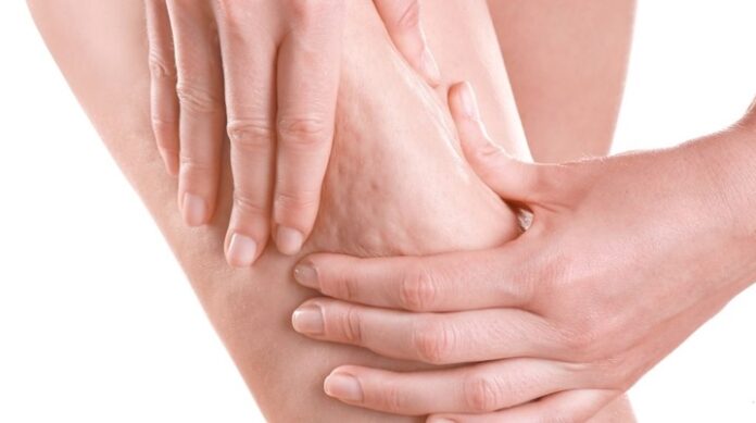 Prof. Dr. Karacalar: Selülit sadece estetik bir sorun değil