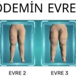 lipodemin-evreleri_092203772
