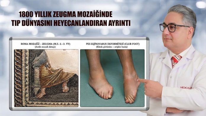 Gaziantep'te sergilenen 1800 yıllık Zeugma mozaiğinde dikkat çeken tıbbi ayrıntı merak uyandırdı